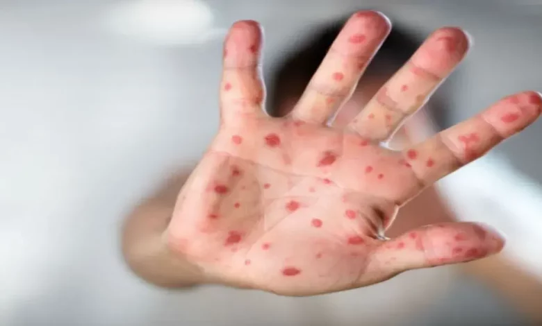 El Ministerio de Salud confirmó un caso de sarampión en el país